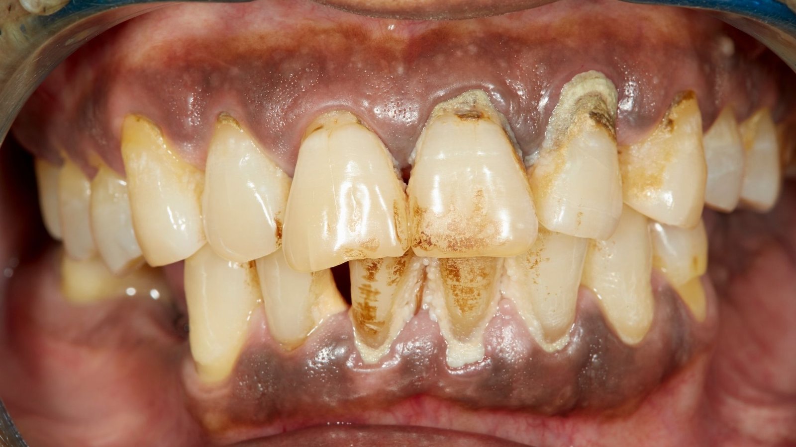 periodontal disease